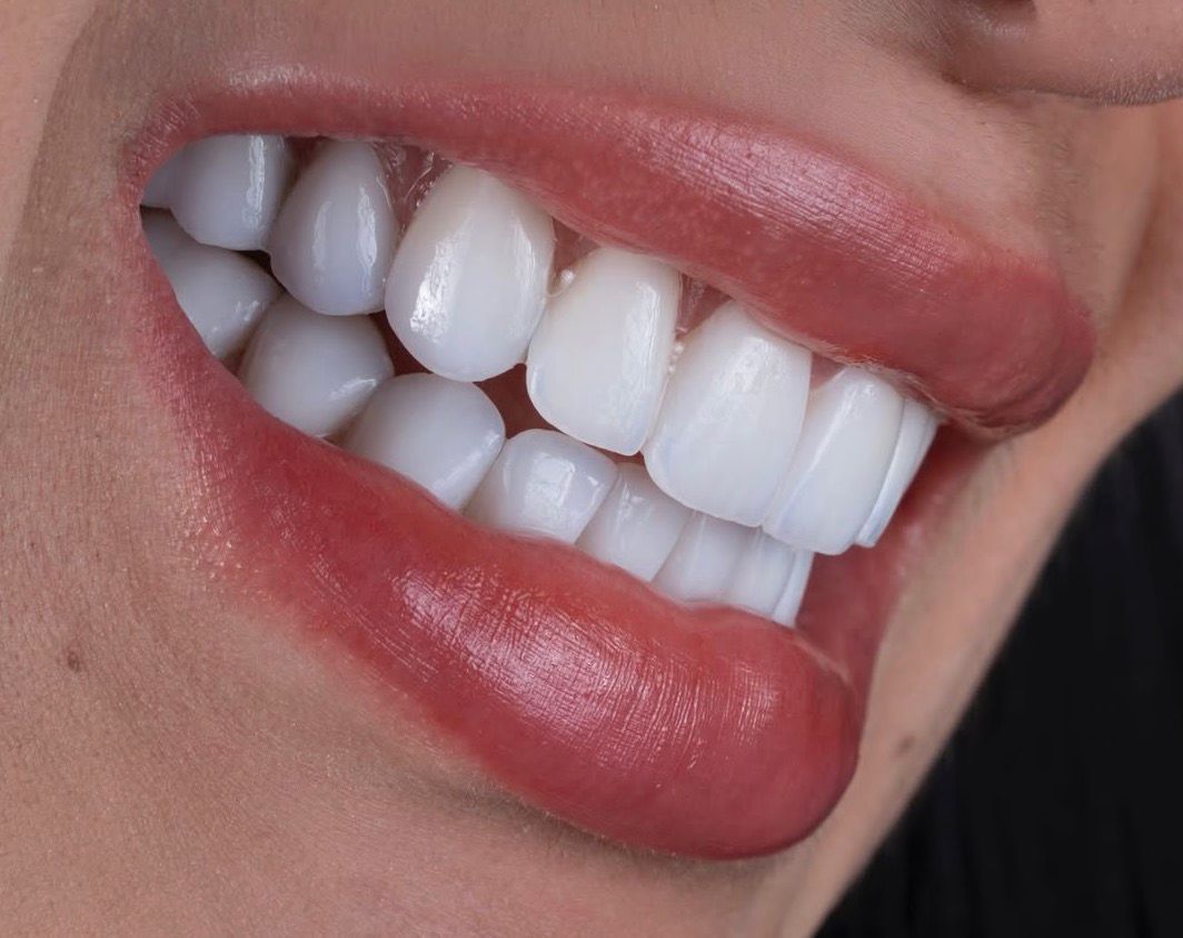 Perfect Smile